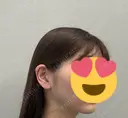 糸リフト / 脂肪吸引（顔） 脂肪吸引ラボトウキョウ DAY 63 サムネイル用