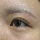 眉下切開 Barbie Clinic AFTER サムネイル用