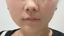 その他（鼻） / ボトックス（あご） / ボトックス（口角） / ボトックス（眉間） / ボトックス（人中） TCB東京中央美容外科 岡山院 DAY 6 サムネイル用