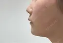 その他（鼻） / ボトックス（あご） / ボトックス（口角） / ボトックス（眉間） / ボトックス（人中） TCB東京中央美容外科 岡山院 DAY 6 サムネイル用