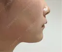 その他（鼻） / ボトックス（あご） / ボトックス（口角） / ボトックス（眉間） / ボトックス（人中） TCB東京中央美容外科 岡山院 DAY 6 サムネイル用