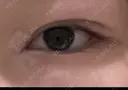 二重埋没 / 目頭切開 かめい美容クリニック宇都宮 DAY 31 サムネイル用