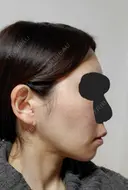 糸リフト / バッカルファット除去 / 脂肪吸引（顔） / ジョールファット除去 / ボトックス（エラ・小顔） アリエル美容クリニック 大宮院 DAY 97 サムネイル用