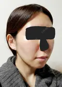 糸リフト / バッカルファット除去 / 脂肪吸引（顔） / ジョールファット除去 / ボトックス（エラ・小顔） アリエル美容クリニック 大宮院 DAY 97 サムネイル用