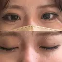 二重埋没 / 上まぶたの脂肪取り アリエル美容クリニック 横浜院 DAY 3 サムネイル用