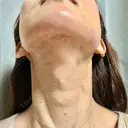 RF（高周波）たるみ治療 TUNE CLINIC【チューンクリニック】 DAY 0 サムネイル用