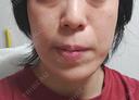RF（高周波）たるみ治療 OMC 表参道院 DAY 47 サムネイル用