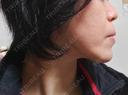 RF（高周波）たるみ治療 OMC 表参道院 DAY 57 サムネイル用