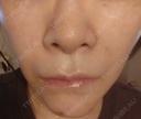 脂肪溶解注射（顔） / ヒアルロン酸注入（鼻翼基部） / ヒアルロン酸注入（ほうれい線） 目白ホワイトクリニック DAY 5 サムネイル用