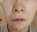 脂肪溶解注射（顔） 目白ホワイトクリニック DAY 4 サムネイル用