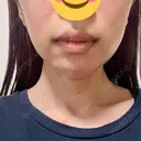 RF（高周波）たるみ治療 TUNE CLINIC【チューンクリニック】 DAY 1 サムネイル用