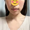 RF（高周波）たるみ治療 TUNE CLINIC【チューンクリニック】 DAY 0 サムネイル用