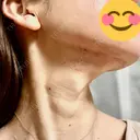 RF（高周波）たるみ治療 TUNE CLINIC【チューンクリニック】 DAY 0 サムネイル用