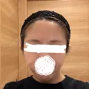 脂肪注入（額） EMMA CLINIC（エマクリニック） AFTER サムネイル用