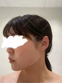 脂肪吸引（顔） / 脂肪吸引（二の腕） Mods Clinic（モッズクリニック） 福岡院 DAY 90 サムネイル用