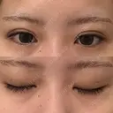 二重埋没 / 上まぶたの脂肪取り アリエル美容クリニック 横浜院 DAY 4 サムネイル用