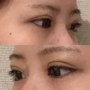二重埋没 / 上まぶたの脂肪取り アリエル美容クリニック 横浜院 DAY 4 サムネイル用