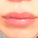 ヒアルロン酸注入（唇） アネシス美容クリニック DAY 2 サムネイル用