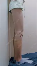 脂肪吸引（脚） ドクターフィット（Dr.fit）クリニック DAY 10 サムネイル用