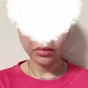 糸リフト / 脂肪吸引（顔） EMMA CLINIC（エマクリニック） AFTER サムネイル用