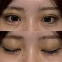 二重埋没 / 上まぶたの脂肪取り アリエル美容クリニック 横浜院 DAY 5 サムネイル用