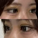 二重埋没 / 上まぶたの脂肪取り アリエル美容クリニック 横浜院 DAY 5 サムネイル用