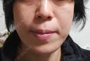 RF（高周波）たるみ治療 OMC 表参道院 AFTER サムネイル用