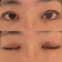 二重埋没 水の森美容クリニック 横浜院 DAY 1 サムネイル用