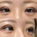 二重埋没 / ヒアルロン酸注入（涙袋） EMMO FACE CLINIC 東京三田院 DAY 1 サムネイル用
