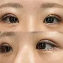 二重埋没 / ヒアルロン酸注入（涙袋） EMMO FACE CLINIC 東京三田院 DAY 1 サムネイル用