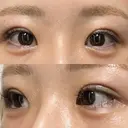 二重埋没 / ヒアルロン酸注入（涙袋） EMMO FACE CLINIC 東京三田院 DAY 31 サムネイル用