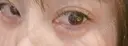 ヒアルロン酸注入（涙袋） ネビュラクリニック 東京錦糸町院 DAY 3 サムネイル用