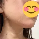 RF（高周波）たるみ治療 TUNE CLINIC【チューンクリニック】 AFTER サムネイル用