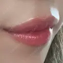 ヒアルロン酸注入（唇） / ヒアルロン酸注入（目の下） KIMI CLINIC 形成・美容外科 DAY 9 サムネイル用