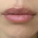 ヒアルロン酸注入（唇） アネシス美容クリニック DAY 4 サムネイル用