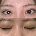 二重埋没 / 上まぶたの脂肪取り アリエル美容クリニック 横浜院 DAY 6 サムネイル用