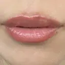 ヒアルロン酸注入（唇） アネシス美容クリニック DAY 5 サムネイル用