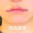 口角挙上 / ボトックス（人中） LOUIS CLINIC 二子玉川院【ルイクリニック】 DAY 1 サムネイル用
