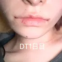 口角挙上 / ボトックス（人中） LOUIS CLINIC 二子玉川院【ルイクリニック】 DAY 1 サムネイル用