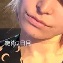 口角挙上 / ボトックス（人中） LOUIS CLINIC 二子玉川院【ルイクリニック】 DAY 1 サムネイル用