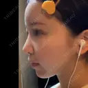 鼻尖形成（切開） / 小鼻縮小（切開） / 軟骨移植 / 鼻柱下降・鼻唇角形成（猫手術） / ヒアルロン酸注入（あご） グローバルビューティークリニック 東京院 AFTER サムネイル用