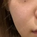 ピーリング（ニキビ・毛穴） Lumiera Clinic AFTER サムネイル用