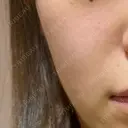 ピーリング（ニキビ・毛穴） Lumiera Clinic DAY 0 サムネイル用