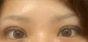 二重埋没 / 自然癒着法 eクリニック 岡山院 DAY 7 サムネイル用