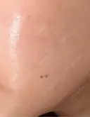 その他（肌） / 美肌レーザー こまちクリニック DAY 24 サムネイル用