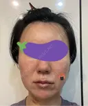 糸リフト Olino美容外科・美容皮膚科 AFTER サムネイル用