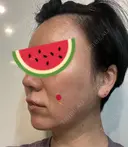糸リフト Olino美容外科・美容皮膚科 DAY 64 サムネイル用