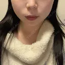 ヒアルロン酸注入（あご） / ボトックス（エラ・小顔） ルラ美容クリニック 名古屋本院 AFTER サムネイル用