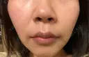 脂肪溶解注射（顔） AZ BEAUTY CLINIC AFTER サムネイル用