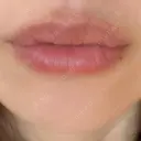 ヒアルロン酸注入（唇） アネシス美容クリニック DAY 6 サムネイル用